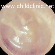 التهاب الأذن الوسطي عند الأطفال